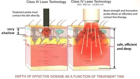 Comparison of Class III vs. Class IV laser therapy showing that Class IV laser delivers more effective tissue penetration.
